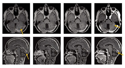 Fig A: These magnetic resonance images show responses in two patients with recurrent sonic hedgehog–subgroup medullo-blastoma (MB) treated with vismodegib. Images were obtained at the start of therapy and at 2, 4, and 6 months after. Gold arrows indicate recurrent lesions. After initial response, MB recurs locally.